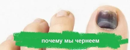 Защо очерни ноктите в женски причини, как да се лекува