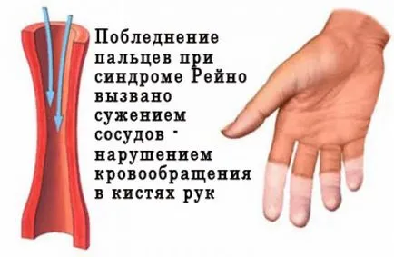Защо ръце са винаги студени, студени ръце и крака какво да правят