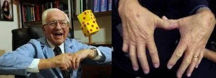 Защо пращене стави, кликнете върху ставите причина пращене фуги по цялото тяло и в пръстите на ръцете,