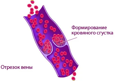 Причини, симптоми и тромбоза симптоми, как да се отнасяме тромбоза и възможните последствия (причина) Причини, симптоми и тромбоза симптоми, как да се отнасяме тромбоза и възможните последствия