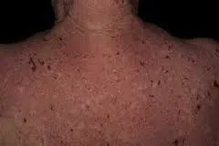 Прости хронично лечение на херпес зостер, прогноза, симптоми, диагностика, каузи