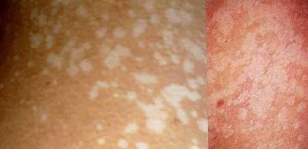 Pityriasis лишей - снимка при хора, лечение, лекарства