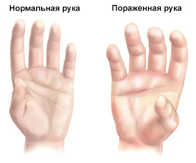 Синдром zudeka лечение етап