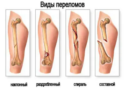 синдром на комплексна местна болка специфичност на заболяване, неговите симптоми, тригери, третиране (лечение) синдром на комплексна местна болка специфичност на заболяване, неговите симптоми, тригери, лечението