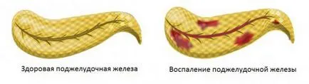 Симптомите и лечение на панкреатични заболявания на