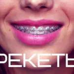 Колко дълго трябва да носи шини - корекция на времето