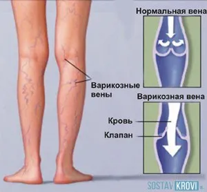 Съдова болест видове крака, симптоми, лечение, народни средства за защита и превенция (заболяване) Съдови заболявания краката видове, симптоми, лечение, народни средства за защита и превенция