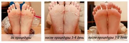Пукнатини по стъпалата, петите, пръстите на краката, стъпалата и краката - снимки, видео (пукнатини) Пукнатини по стъпалата, петите, пръстите на краката, стъпалата и краката - снимки, видео