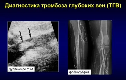 Тромбоза на типовете, причини, признаци, симптоми и лечение на (видове) Тромбоза на типовете, причини, признаци, симптоми и лечение