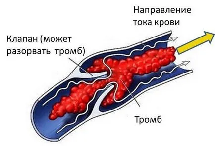 Тромбоза на видовете, причинява, признаци, симптоми и лечение (тромбоза) Тромбоза на типовете, причини, признаци, симптоми и лечение