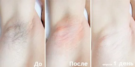 Отстраняването на космите постоянно у дома съвети и техники