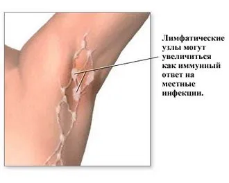 Увеличението на аксиларните лимфни възли - отговори и съвети