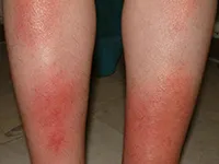 Васкулит какъв вид заболяване, симптомите и как да се отнасяме