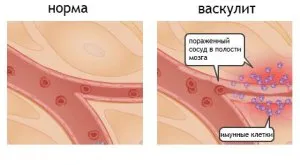 Васкулитни - причини, симптоми, диагностика, лечение