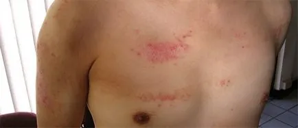 Видове лишаване на лицето и първите признаци на заболяването (видове) Видове лишаване на лицето и първите признаци на заболяването