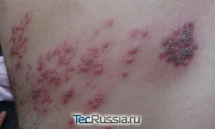 Видове лишава кожата, ръцете и човешкото тяло - снимка, симптоми и лечение