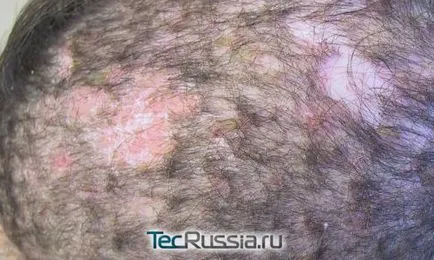Видове лишава кожата, ръцете и човешкото тяло - снимка, симптоми и лечение