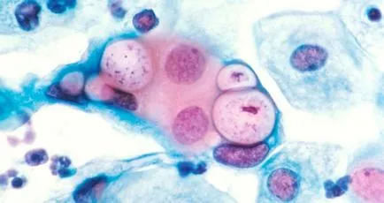 Chlamydia това е, видовете, причини, симптоми, лечение, профилактика