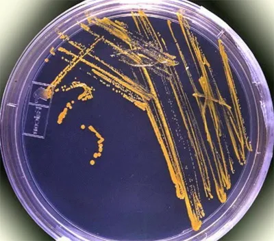 симптоми и лечение Staphylococcus ауреус, както са докладвани от стафилококова инфекция