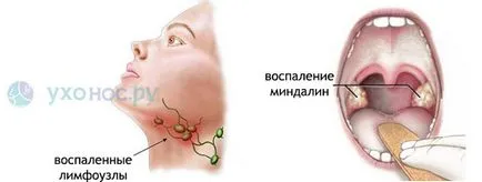 Аденовирус инфекция е Аденовирус инфекция е