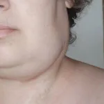 Възпалени лимфни възли отколкото лечение
