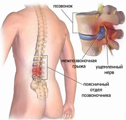 Какво да правим с херния на гръбначния стълб