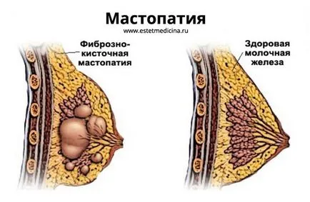 Как да премахнете фиброаденом на гърдата