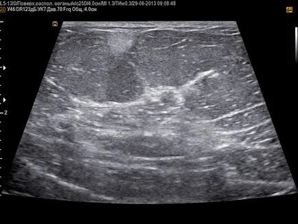 Fibrolipoma какво е