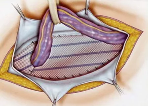 Hernioplasty (херния) - Какво е това, хирургия, цени, видео