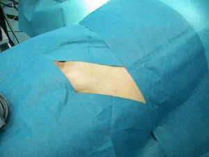 Hernioplasty (херния) - Какво е това, хирургия, цени, видео