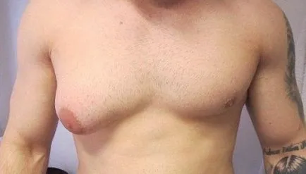 Гинекомастията при мъжете