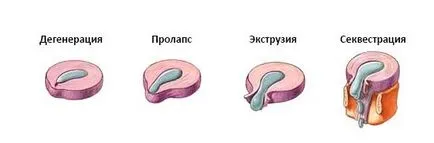 гръбначния херния - причини, симптоми, лечение, профилактика