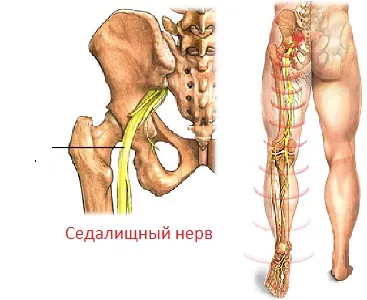 Ишиас симптоми, причини, лечение, превенция