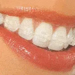 Bite корекция в снимката на детето преди и след