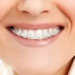 Bite корекция в снимката на детето преди и след