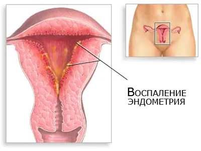Как за лечение на ендометриоза, домашни методи