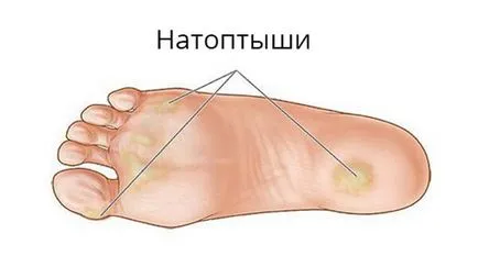 Как за лечение на мазоли по стъпалата на народната медицина и фармацевтични препарати