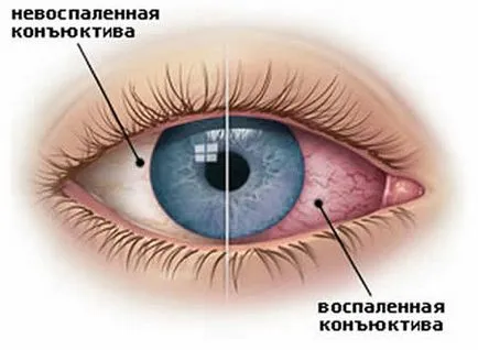 Как за лечение на конюнктивит в дома
