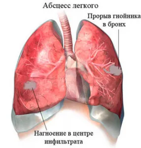 Как за лечение на стафилококус ауреус