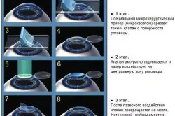 Както се коригира далекогледство