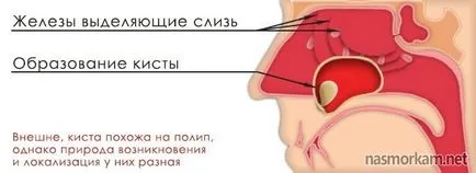Нематода на максиларния синус симптоми, лечение