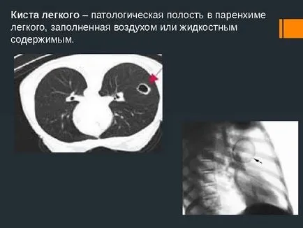 Белодробни киста симптоми, лечение и народни средства