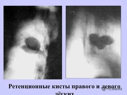 Белодробни киста симптоми, лечение и народни средства