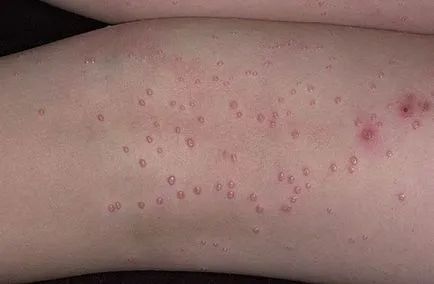 Molluscum контагиозум начини на инфекция, методи за премахване