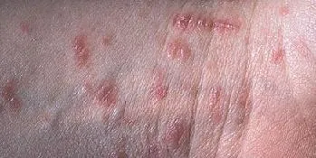 Червени обриви по краката на възрастен снимки, описание, лечение