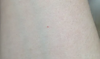 Червени бенки по тялото снимка, причини, лечение, кожни заболявания