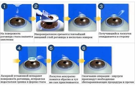 ползи и противопоказания Лазерна корекция на зрението
