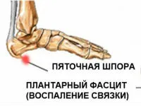 лечение UHT на петата разклонения, инжекции, се обработва с ултразвук и дейности (стимул) Лечение на петата разклонения UHT, инжекции, ултразвук и упражнения