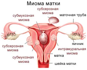 миома на матката лечение на традиционните методи
