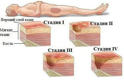 Лечението на рани от залежаване в лежащо болни възрастни хора как и какво да се премахне (рани от залежаване) Лечението на рани от залежаване в лежащо болни възрастни хора как и какво да се премахне